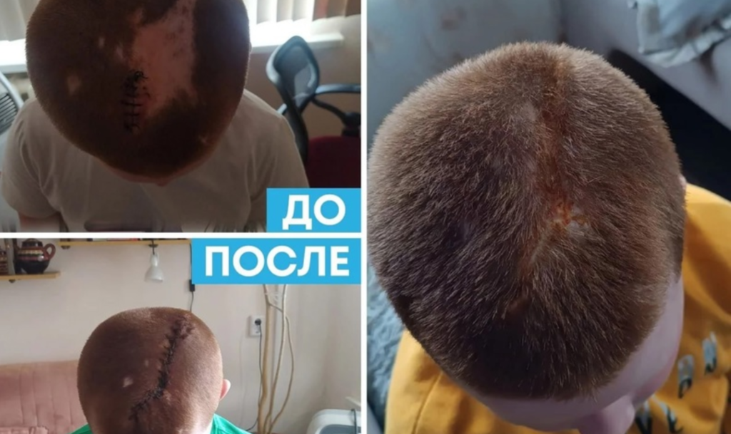 Челябинские врачи восстановили волосы ребенку после серьезного ожога