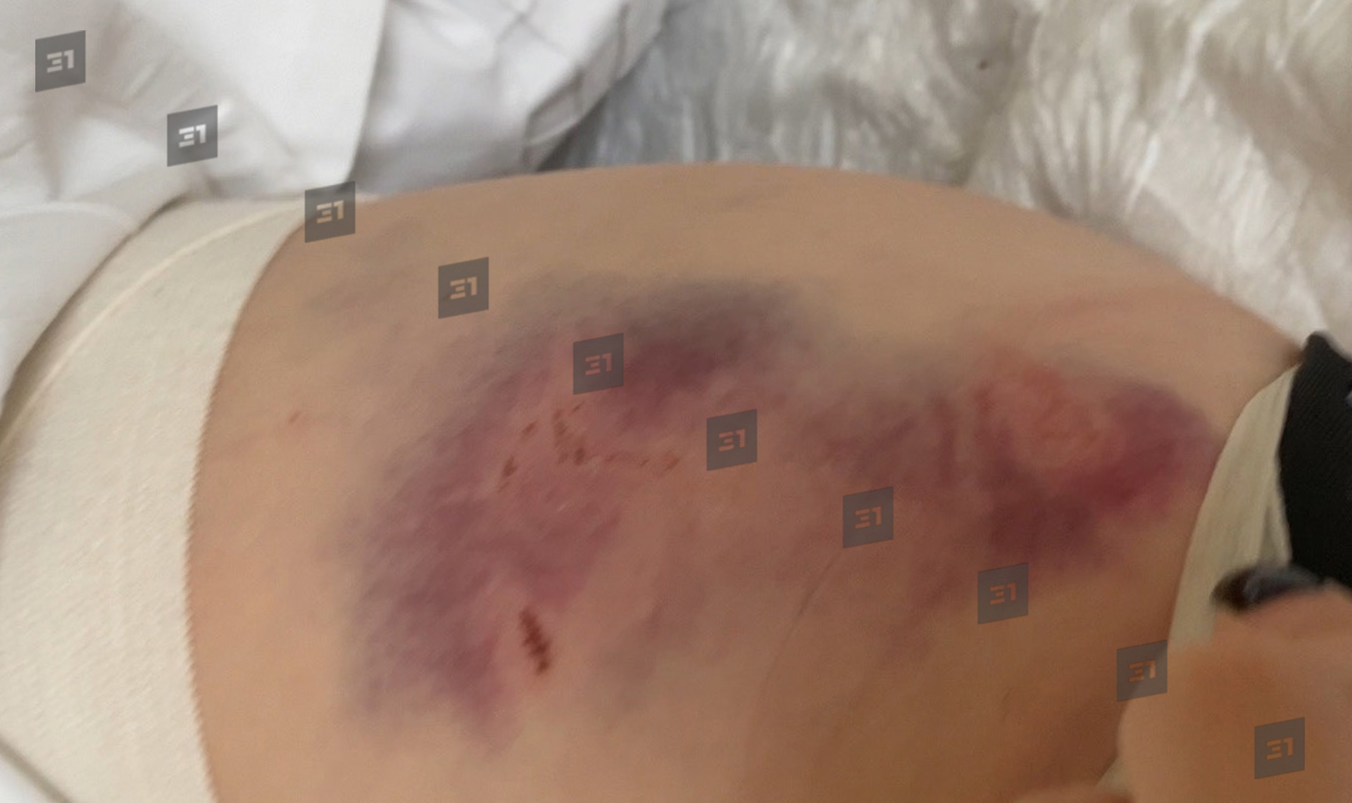 Челябинка, которая переломала кости в жутком ДТП с МАНом, ищет свидетелей аварии