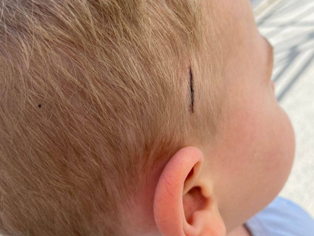 В Миассе произошёл неприятный инцидент в детском саду “Образовательный центр”: мальчик получил серьёзную травму головы