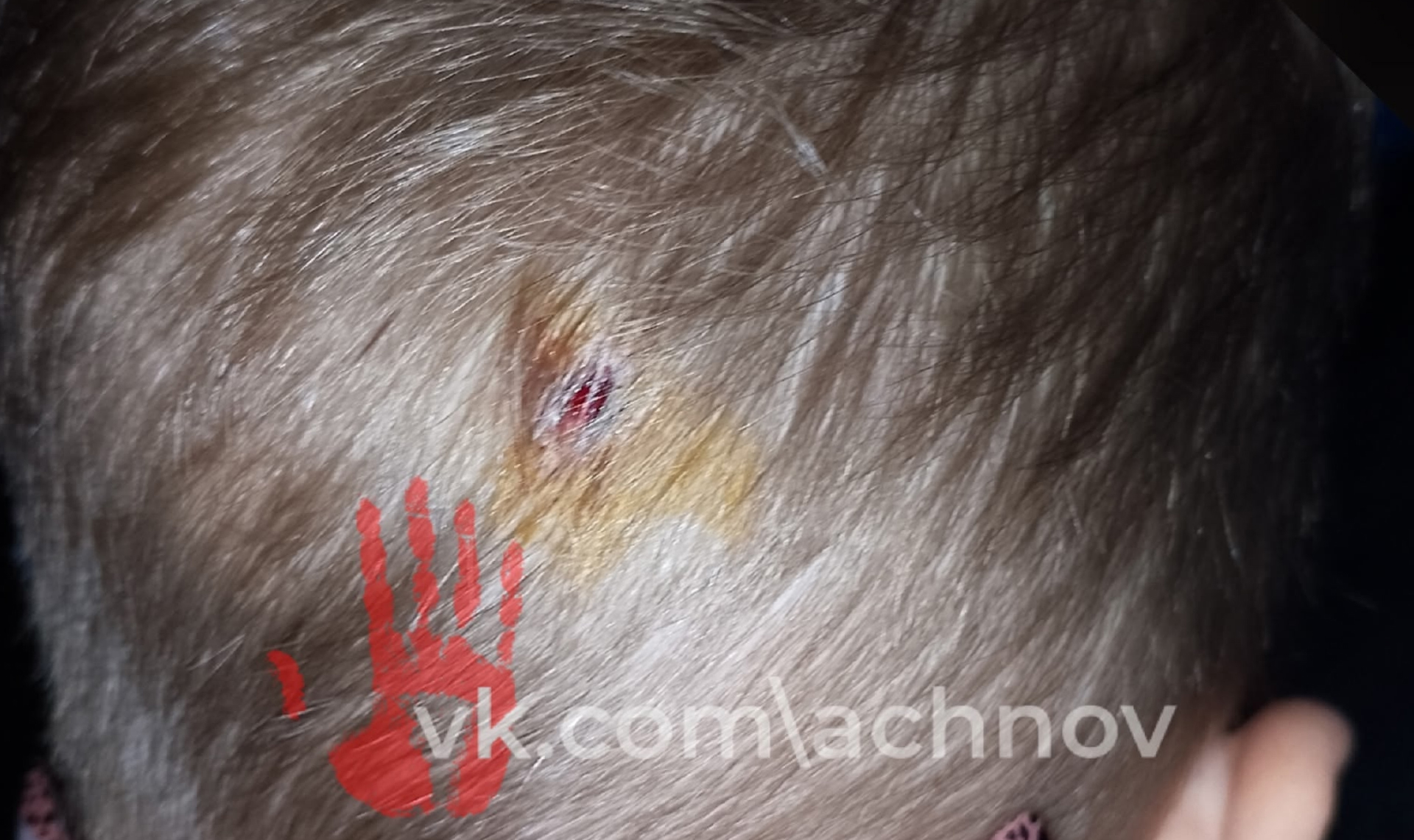 Следователи выясняют, действительно ли малыш из еманжелинского садика пробил голову по вине медика