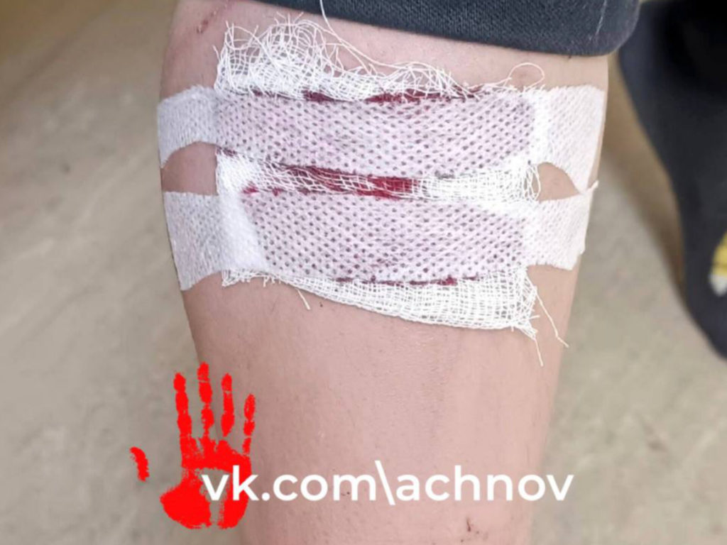 Школьник пострадал от укуса бездомной собаки в Аргаяше!