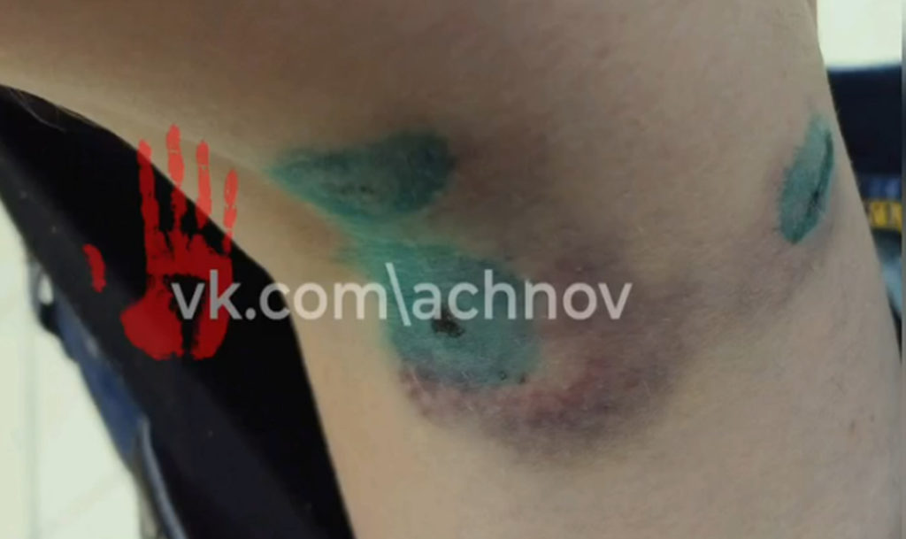 Женщину покусала чужая домашняя собака!