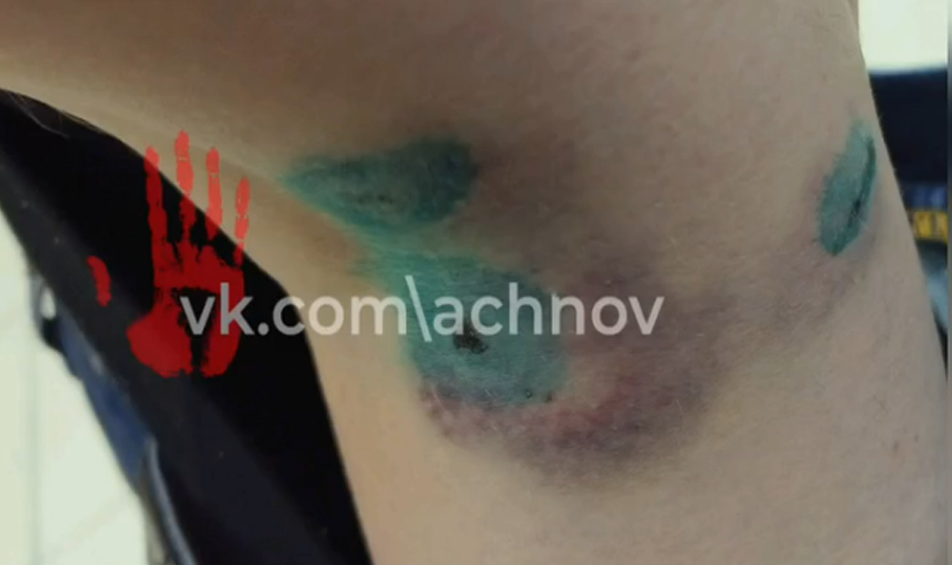 Женщину покусала чужая домашняя собака!